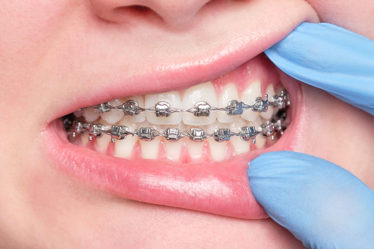Close-up of a dentist gloved hand opening the mouth of a patient with metal bracket system on the teeth of a young woman